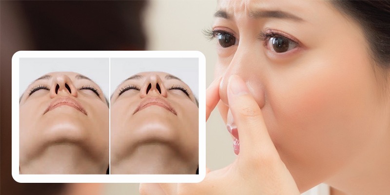 Mũi bị co rút sau nâng mũi do đâu? Dấu hiệu & cách khắc phục hiệu quả mũi bị co rút sau nâng mũi