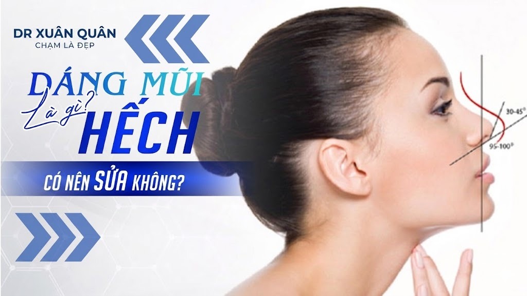 Mũi bị co rút sau nâng mũi do đâu? Dấu hiệu & cách khắc phục hiệu quả mũi bị co rút sau nâng mũi