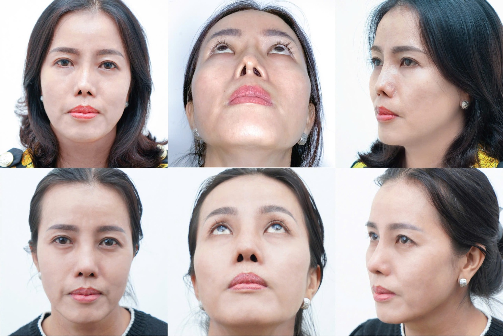 mũi bị tụt sụn