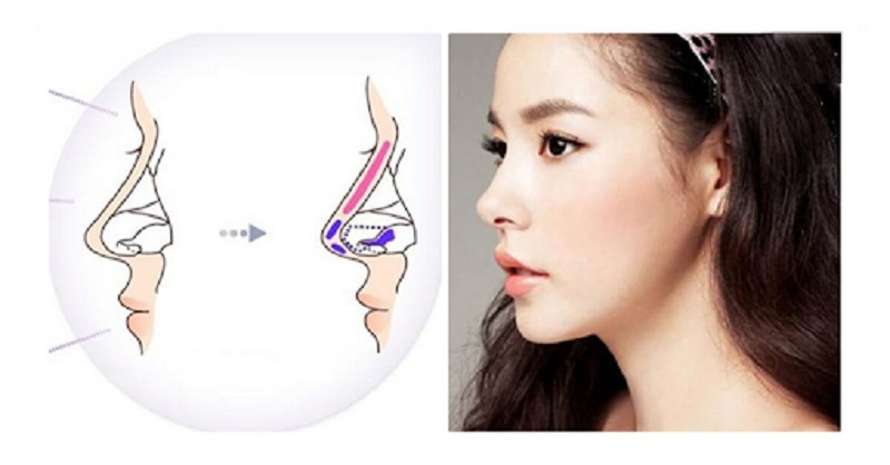 mũi bị tụt sụn