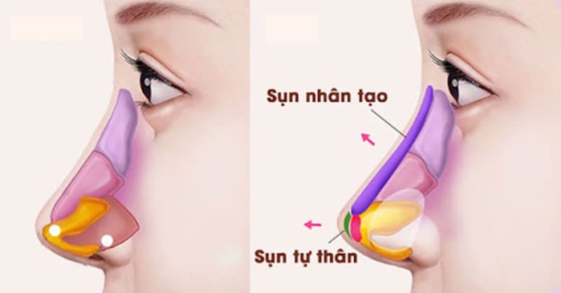 What is semi-structural rhinoplasty? Advantages and suitable candidates Nâng mũi bán cấu trúc