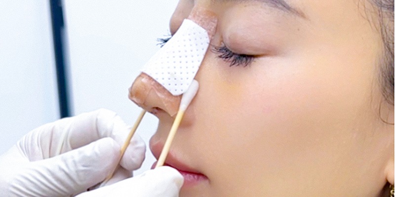 How long after rhinoplasty is the splint removed? Nâng mũi bao lâu tháo nẹp?
