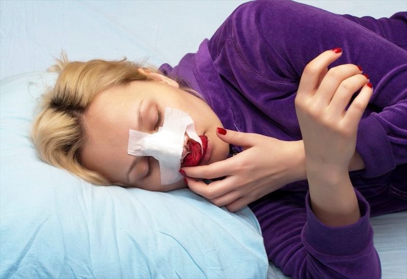 Nâng mũi bao lâu thì được xì mũi và cách vệ sinh mũi sau nâng an toàn Nâng mũi bao lâu thì được xì mũi
