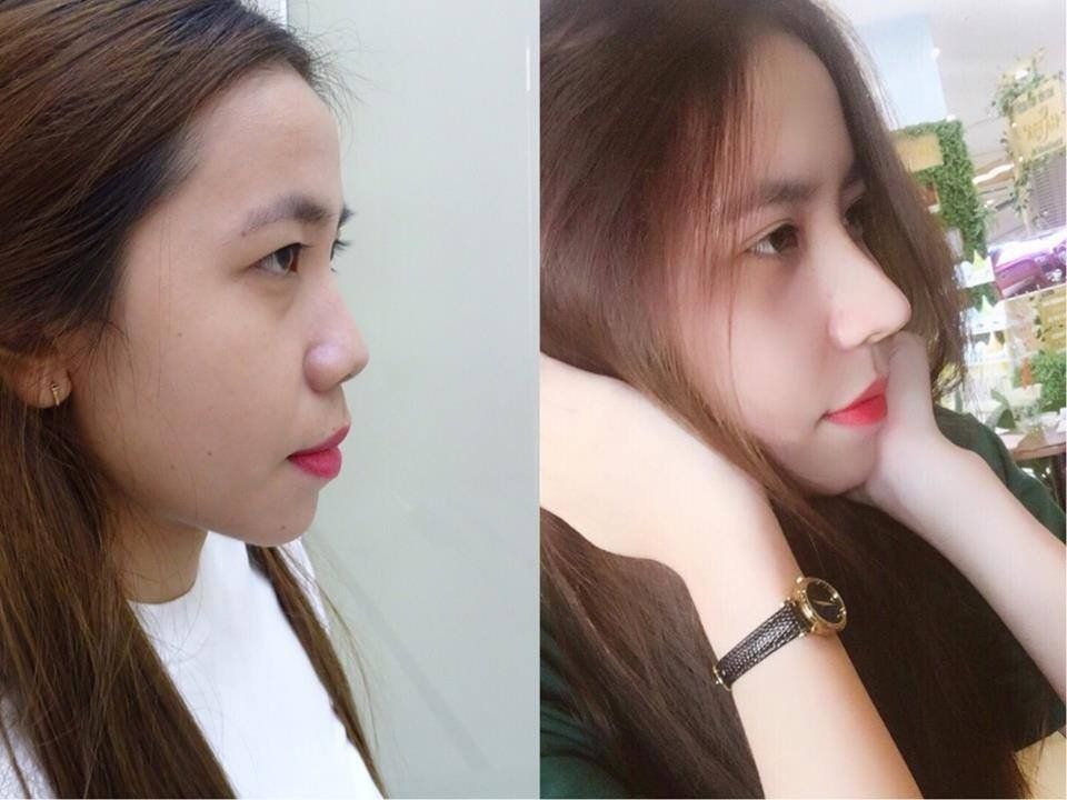 Nâng mũi bao lâu thì được xì mũi và cách vệ sinh mũi sau nâng an toàn Nâng mũi bao lâu thì được xì mũi