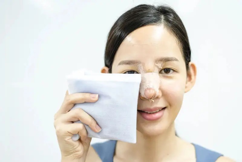 Nâng mũi bị đỏ đầu mũi: Nguyên nhân và cách khắc phục dứt điểm nâng mũi bị đỏ đầu mũi