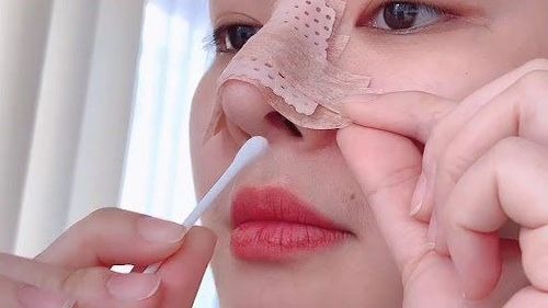 Cẩm nang chăm sóc sau nâng mũi giúp mũi nhanh vào form, đẹp bền vững chăm sóc sau nâng mũi