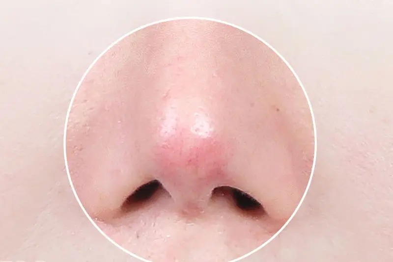 Nâng mũi bị đỏ đầu mũi: Nguyên nhân và cách khắc phục dứt điểm Tại sao nâng mũi bị đỏ đầu mũi?