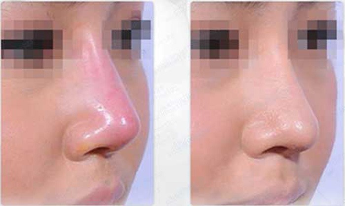 Nâng mũi bị đỏ đầu mũi: Nguyên nhân và cách khắc phục dứt điểm nâng mũi bị đỏ đầu mũi