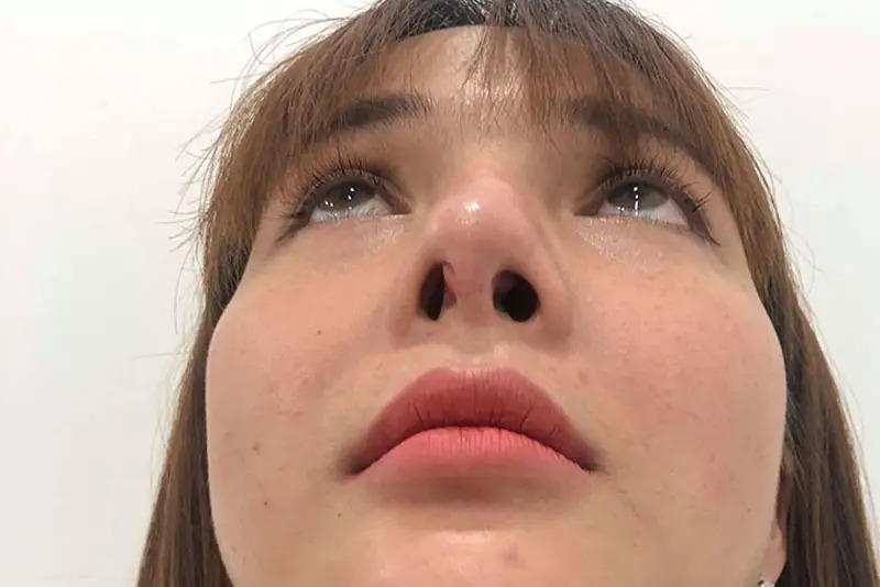 Signs of exposed nasal cartilage and how to fix it Dấu hiệu lộ sụn đầu mũi dễ nhận biết