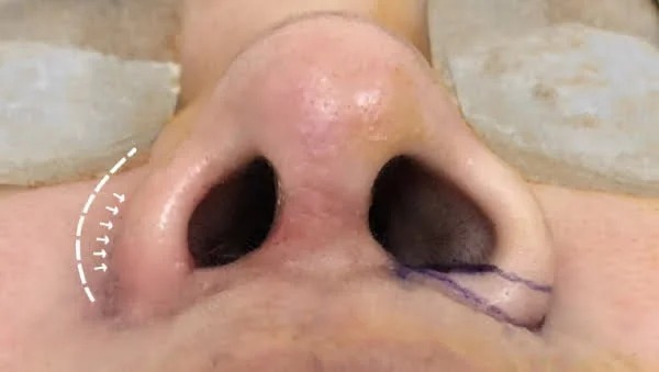 Nâng mũi bị sưng một bên thường do đâu? Nguy hiểm không? Cách xử lý kịp thời nâng mũi bị sưng một bên