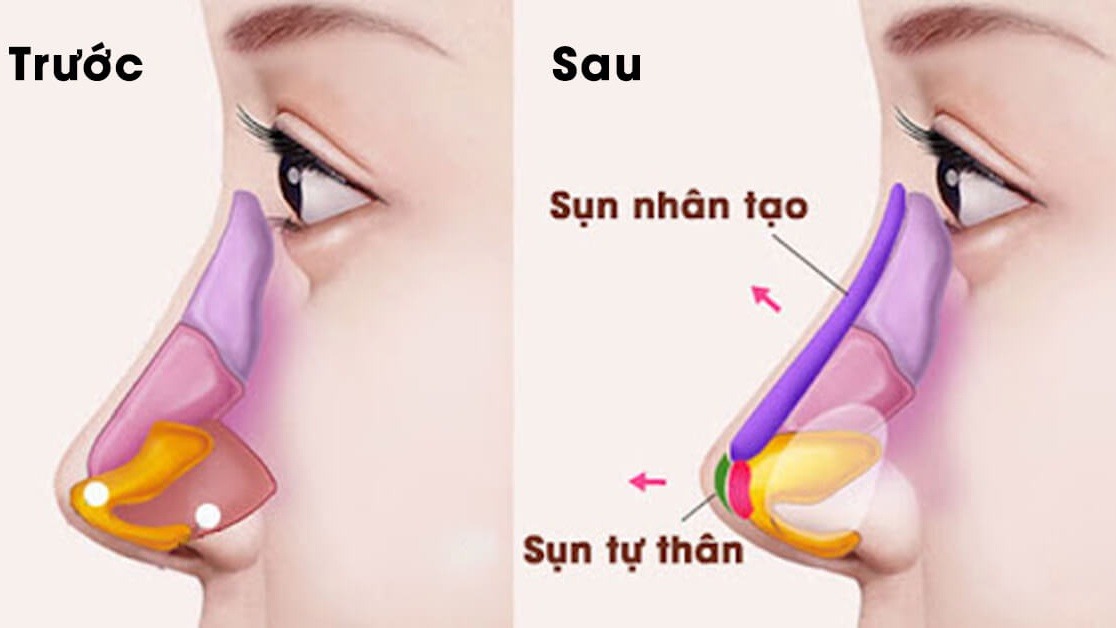 nâng mũi cấu trúc bao lâu thì gom lại