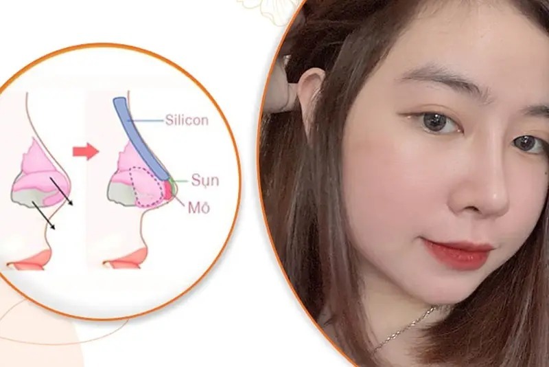 Structural rhinoplasty or cartilage grafting? nâng mũi cấu trúc hay bọc sụn