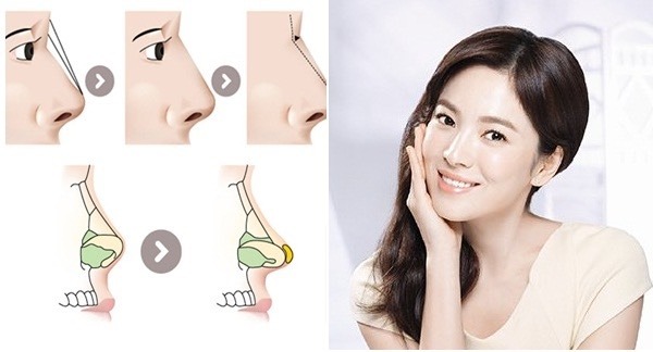 Comparison of structural and semi-structural rhinoplasty Nâng mũi cấu trúc và bán cấu trúc