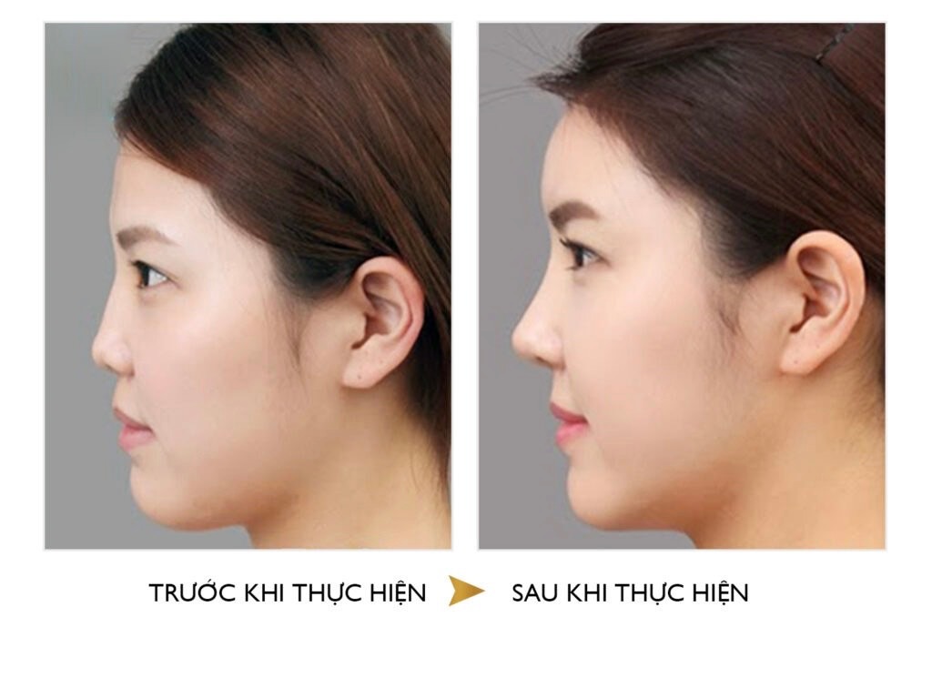 Comparison of structural and semi-structural rhinoplasty Nâng mũi cấu trúc và bán cấu trúc