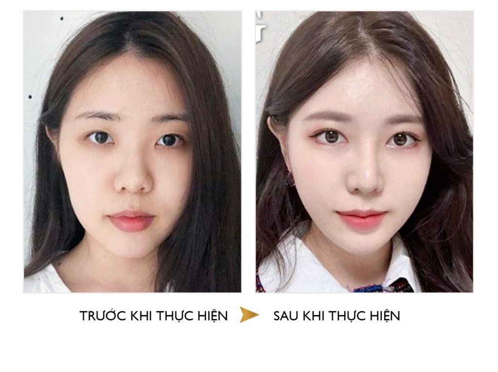 Comparison of structural and semi-structural rhinoplasty Nâng mũi cấu trúc và bán cấu trúc