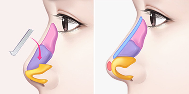 Nâng mũi cấu trúc và bán cấu trúc
