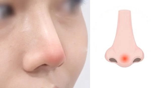 nâng mũi bị đỏ đầu mũi