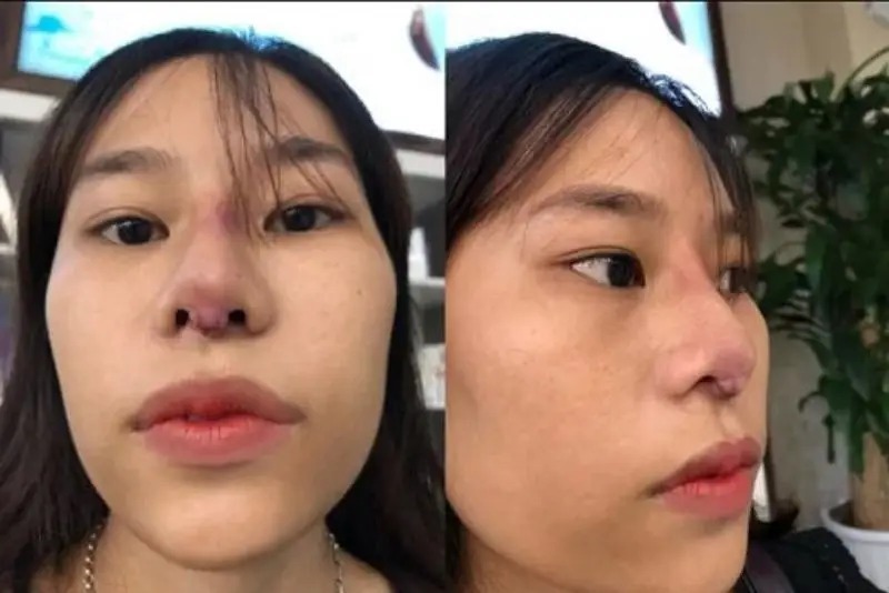 nâng mũi hỏng