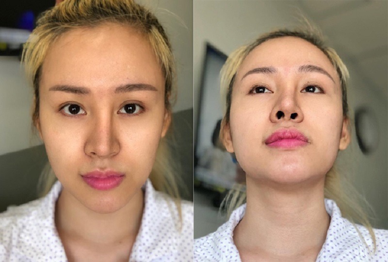 nâng mũi hỏng