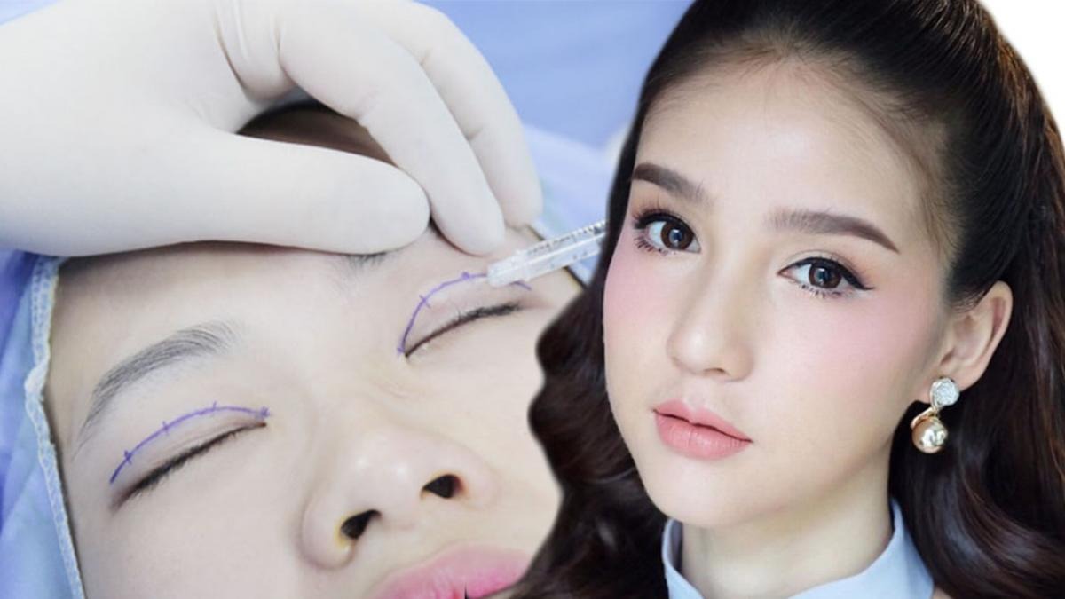 Nhấn mí Quy trình nhấn mí chuẩn y khoa tại Thẩm mỹ Dr Xuân Quân