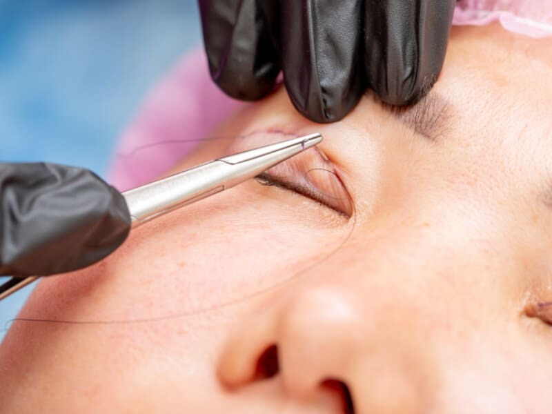 Nguyên nhân và cách khắc phục nhấn mí bị lệch hiệu quả Dấu hiệu nhận biết nhấn mí bị lệch