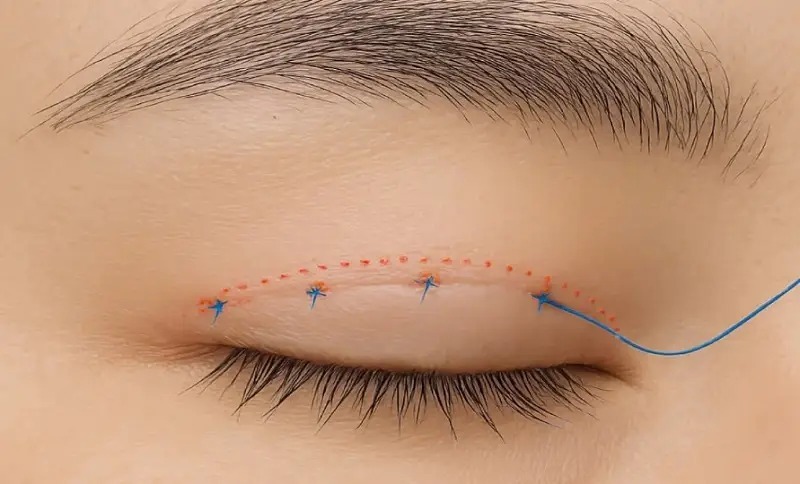 Nhấn mí bị lộ chỉ do đâu? Có khắc phục được không? Những câu hỏi thường gặp về nhấn mí bị lộ chỉ