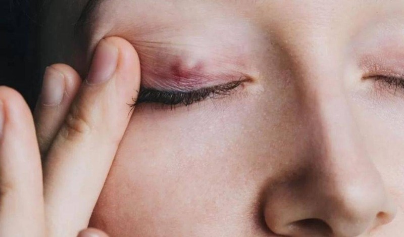 Nhấn mí bị lộ chỉ do đâu? Có khắc phục được không? Nhấn mí bị lộ chỉ có nguy hiểm không?