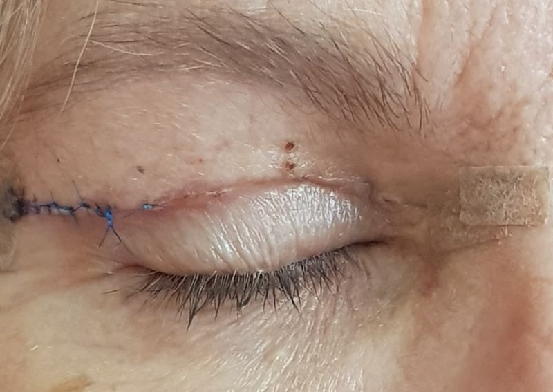 Nhấn mí bị lộ chỉ do đâu? Có khắc phục được không? Tại sao nhấn mí bị lộ chỉ?