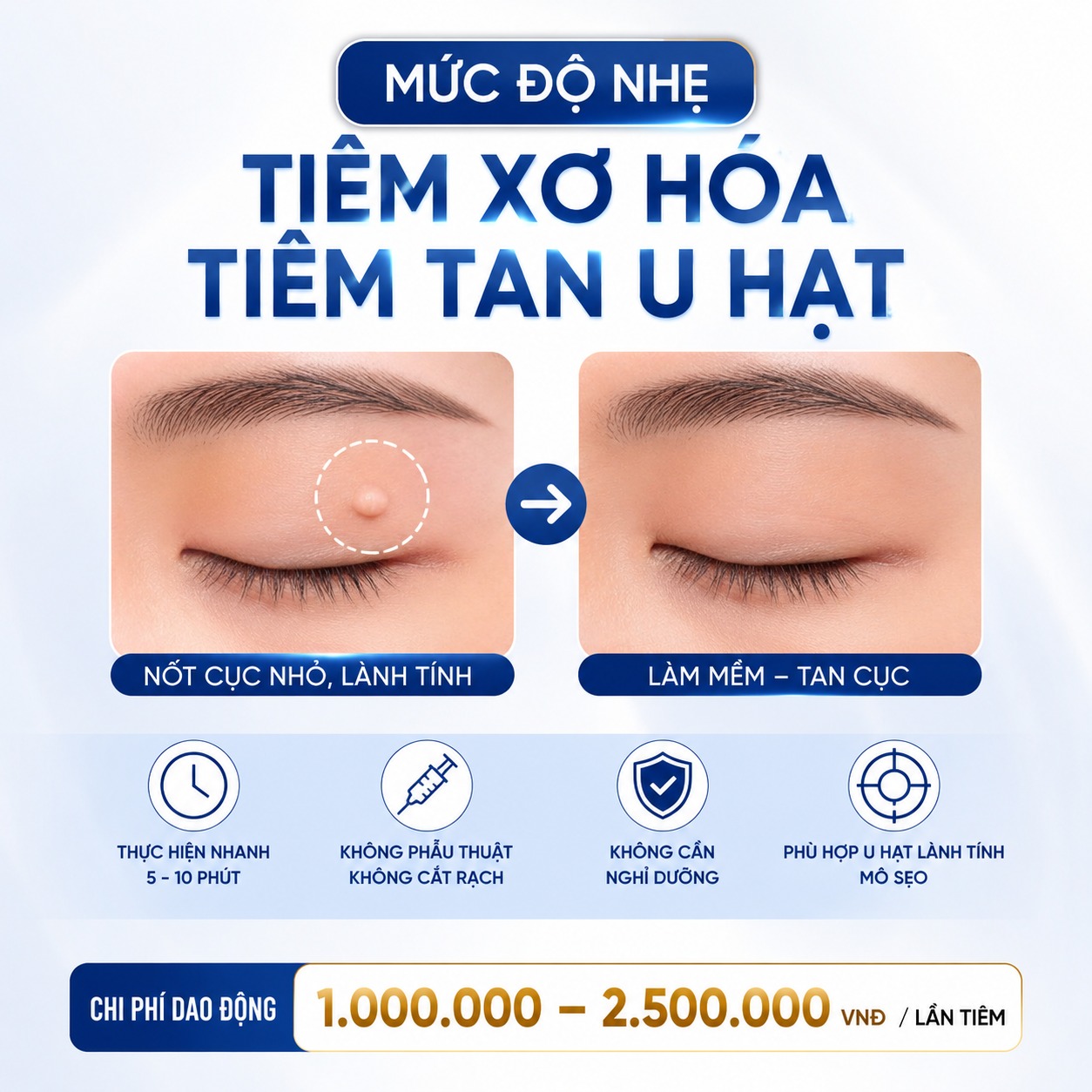 Nhấn mí bị nổi cục: Nguyên nhân, dấu hiệu nguy hiểm và cách xử lý dứt điểm nhấn mí bị nổi cục