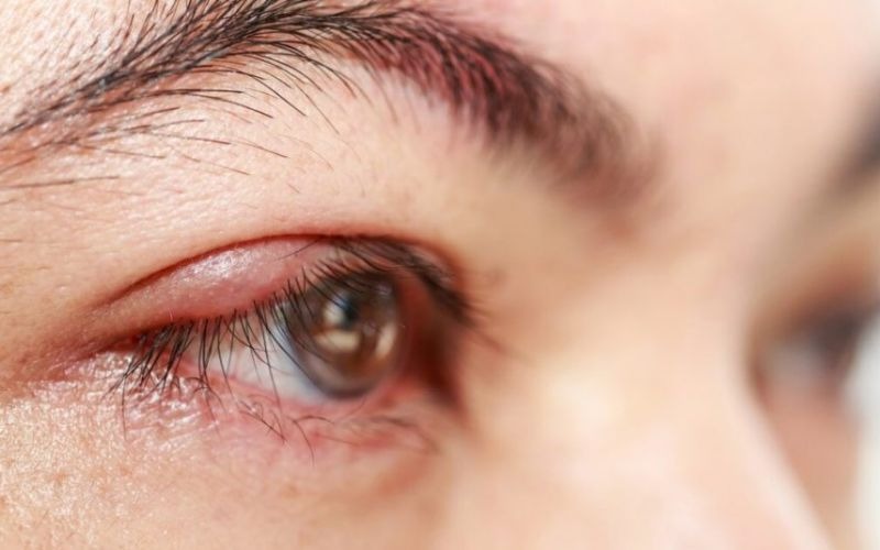 Nhấn mí bị nổi cục: Nguyên nhân, dấu hiệu nguy hiểm và cách xử lý dứt điểm Nhấn mí bị nổi cục có tự hết không?