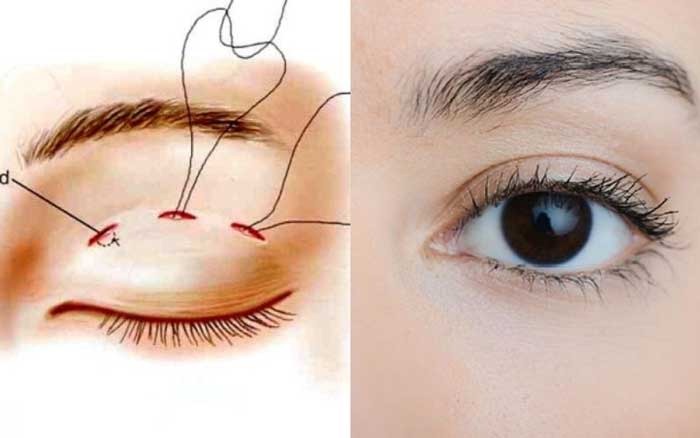 Nhấn mí có an toàn không? Những lưu ý quan trọng bảo vệ đôi mắt Nhấn mí có an toàn không?