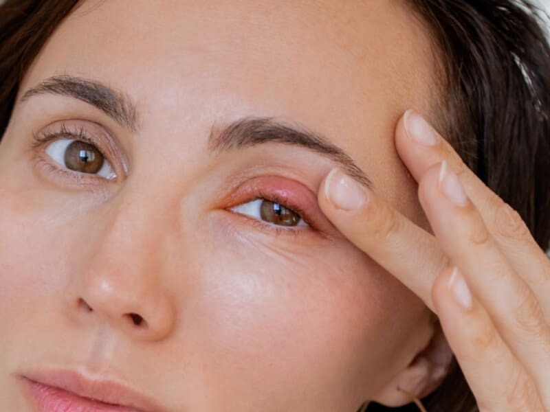 Nhấn mí bị lộ chỉ do đâu? Có khắc phục được không? nhấn mí bị lộ chỉ