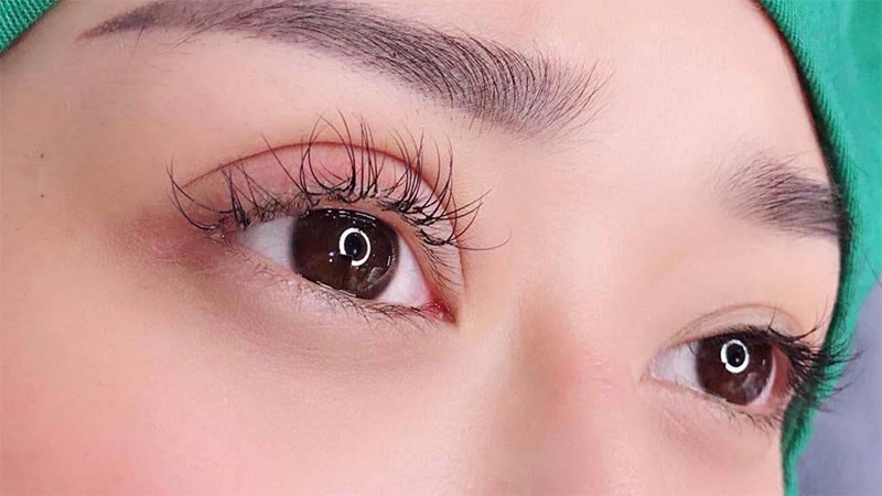 Nhấn mí sưng bao lâu thì hết và đẹp tự nhiên? 5 cách giảm sưng nhanh, an toàn nhấn mí sưng bao lâu thì hết