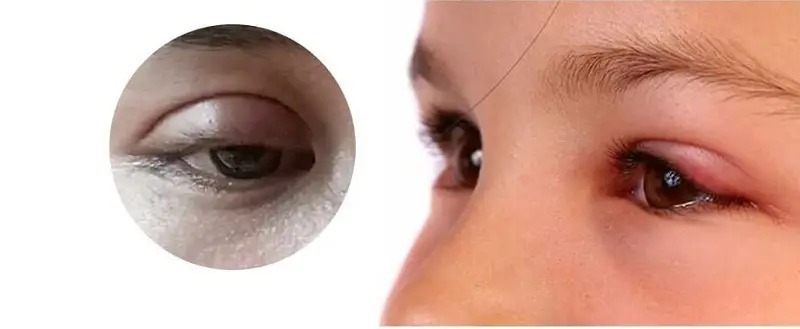 Nhấn mí sưng bao lâu thì hết và đẹp tự nhiên? 5 cách giảm sưng nhanh, an toàn nhấn mí sưng bao lâu thì hết