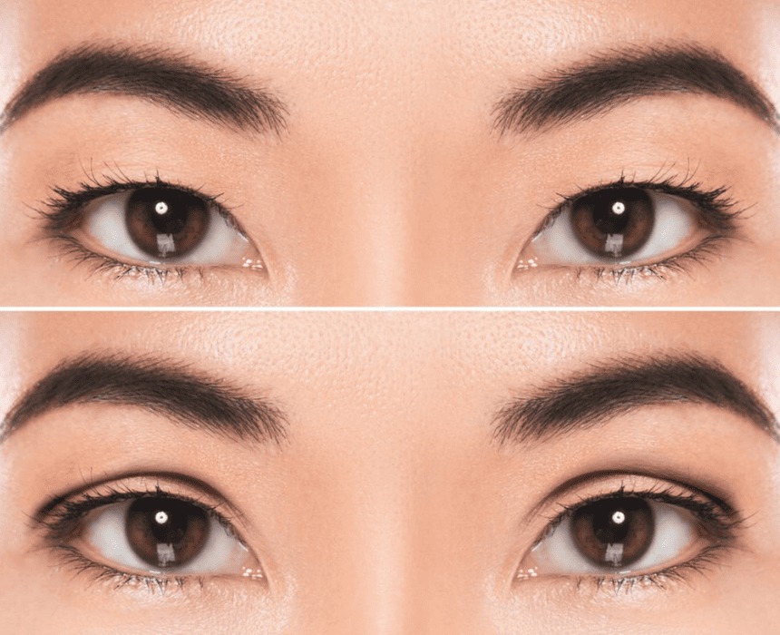 Which is better, eyelid creasing or eyelid surgery? Expert advice nhấn mí và cắt mí cái nào đẹp hơn
