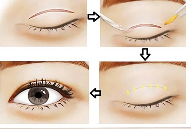 Which is better, eyelid creasing or eyelid surgery? Expert advice nhấn mí và cắt mí cái nào đẹp hơn