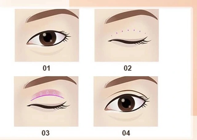 Which is better, eyelid creasing or eyelid surgery? Expert advice nhấn mí và cắt mí cái nào đẹp hơn