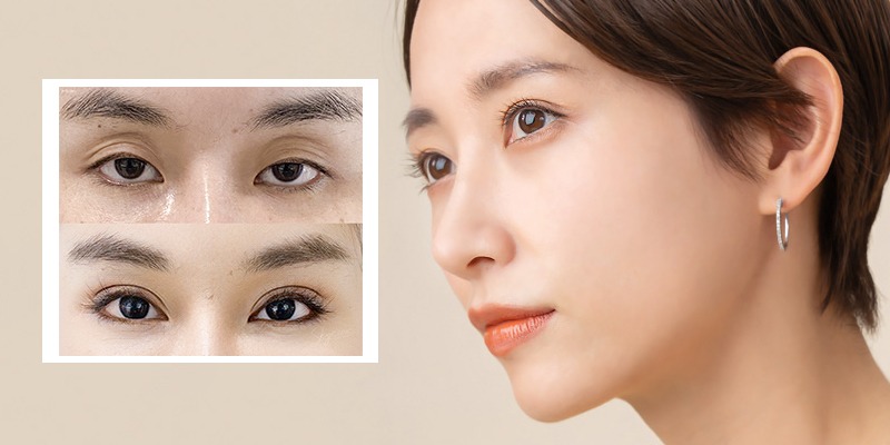Phẫu thuật tạo hình mắt phẫu thuật tạo hình mắt