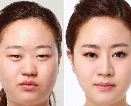 Phẫu thuật tạo hình mắt phẫu thuật tạo hình mắt