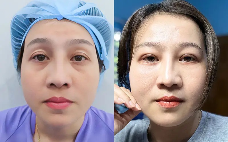 Phẫu thuật tạo hình mắt phẫu thuật tạo hình mắt