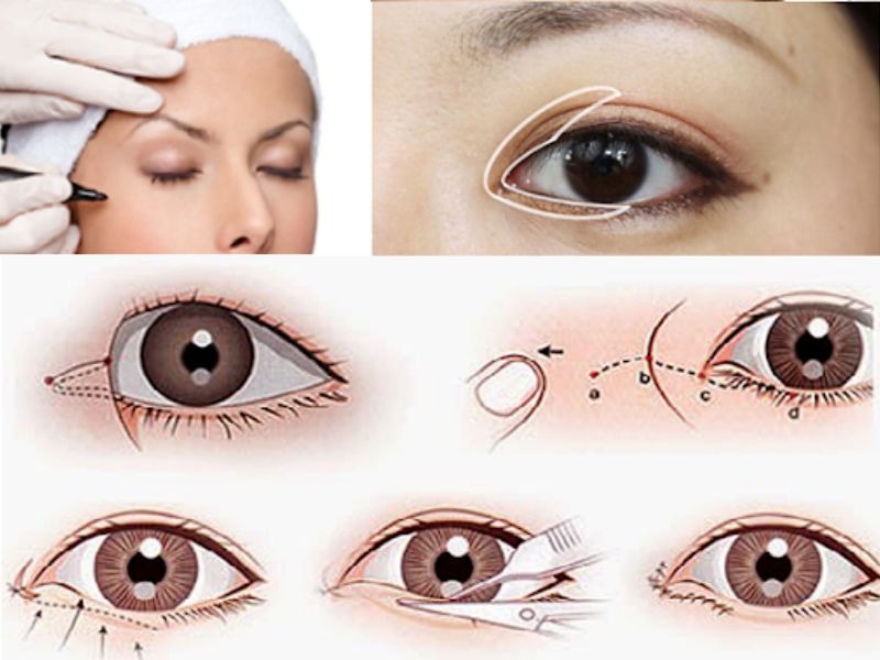 Địa chỉ phẫu thuật thẩm mỹ mắt to mắt nhỏ tốt nhất hiện nay phẫu thuật thẩm mỹ mắt to mắt nhỏ