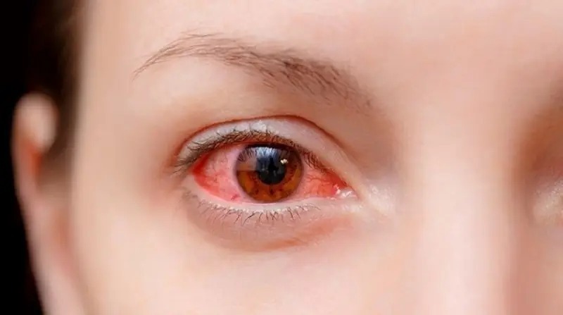 Bị phù kết mạc sau cắt mí có nguy hiểm không? Bao lâu thì hết? phù kết mạc sau cắt mí