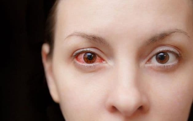 Bị phù kết mạc sau cắt mí có nguy hiểm không? Bao lâu thì hết? phù kết mạc sau cắt mí