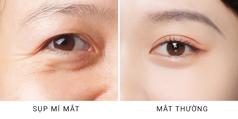 Sụp mí mắt 1 bên do đâu? Cách khắc phục hiệu quả sụp mí mắt 1 bên