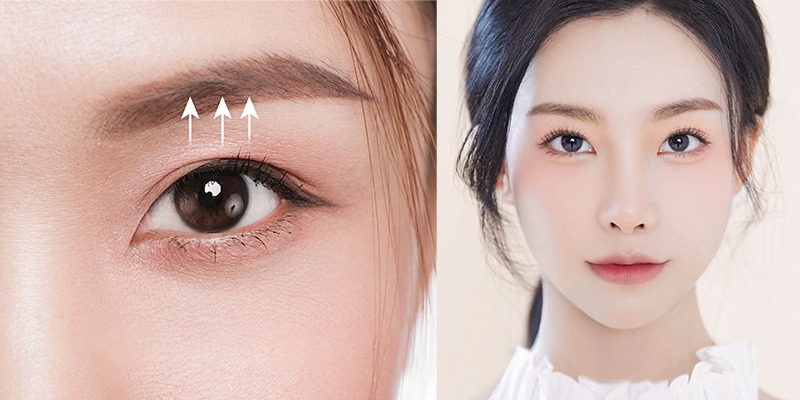 Sụp mí mắt 1 bên do đâu? Cách khắc phục hiệu quả Phương pháp khắc phục sụp mí mắt 1 bên hiệu quả