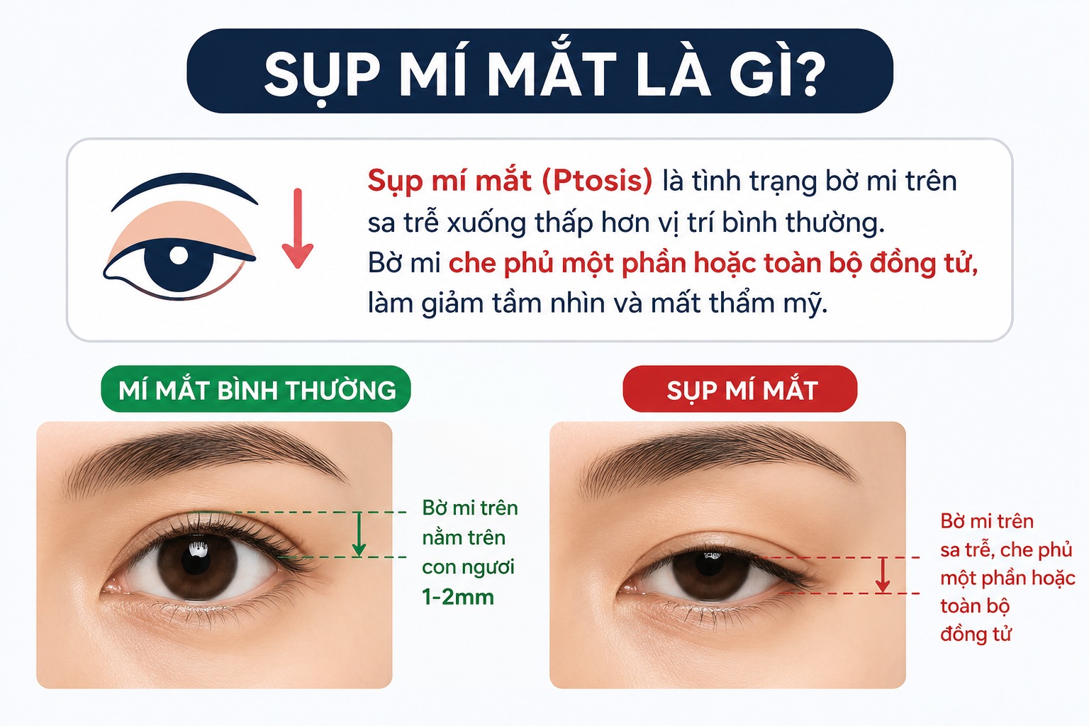 Sụp mí mắt: Nguyên nhân và phương pháp khắc phục hiệu quả Sụp mí mắt là gì?