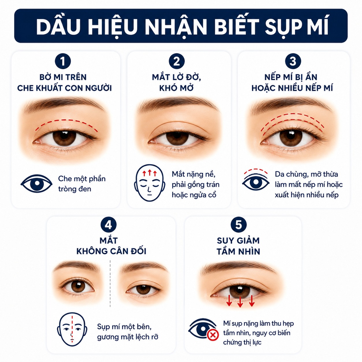 Sụp mí mắt: Nguyên nhân và phương pháp khắc phục hiệu quả Sụp mí mắt là gì? Dấu hiệu nhận biết