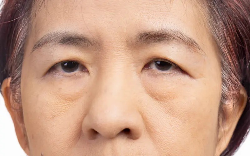 Sụp mí mắt: Nguyên nhân và phương pháp khắc phục hiệu quả sụp mí mắt