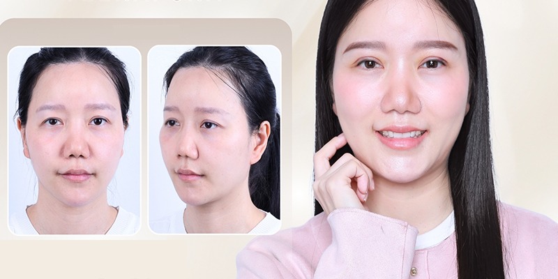 Sụp mí mắt: Nguyên nhân và phương pháp khắc phục hiệu quả sụp mí mắt