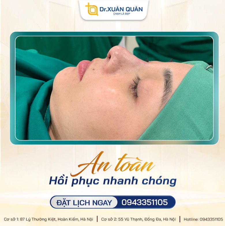 Tháo sụn mũi tháo sụn mũi